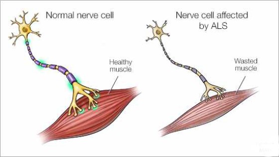 Normální funkční neuron ve srovnání s neuronem poškozeným ALS